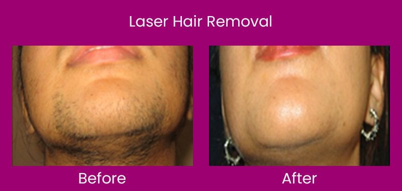 Best Laser Hair Removal In Ahmedabad | Affordable Laser Hair Removal Cost  In Ahmedabad - Amish Hospital