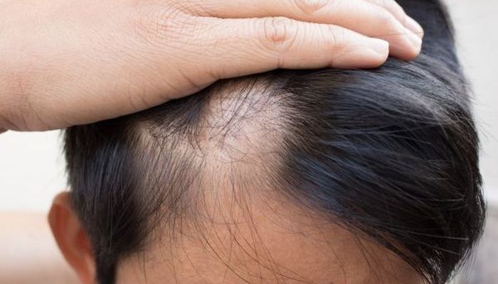 What is the home remedy for hair fall control? - Quora