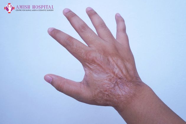 can plastic surgery remove burn scars - blog by amish hospital